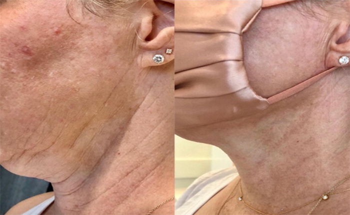 Dermal Fillers Exposed: Watch Fine Lines and Sagging Skin Disappear!