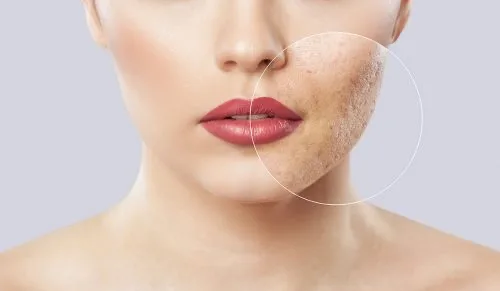 RF Microneedling