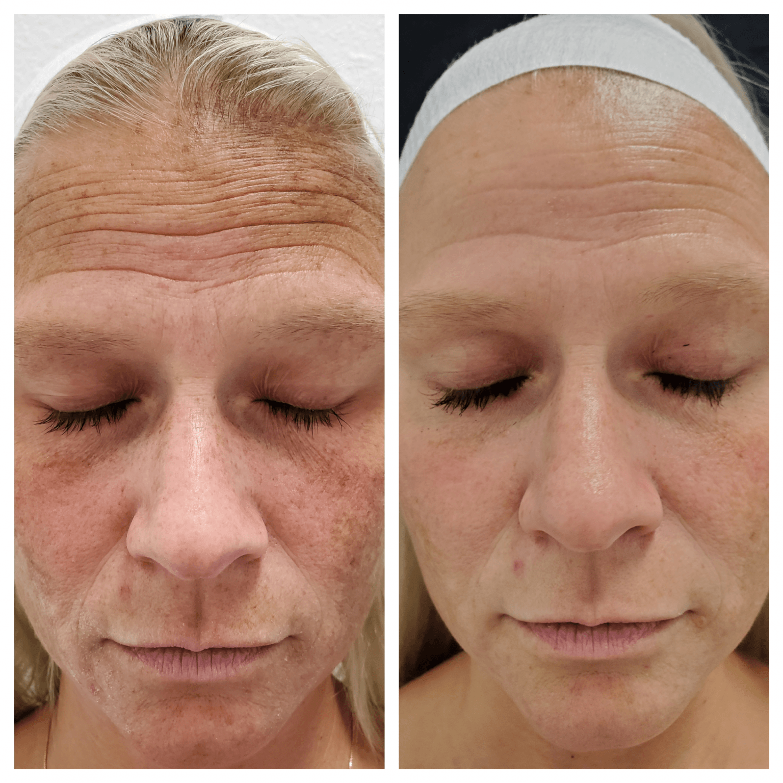 stem cell microneedling 1536x1536 1