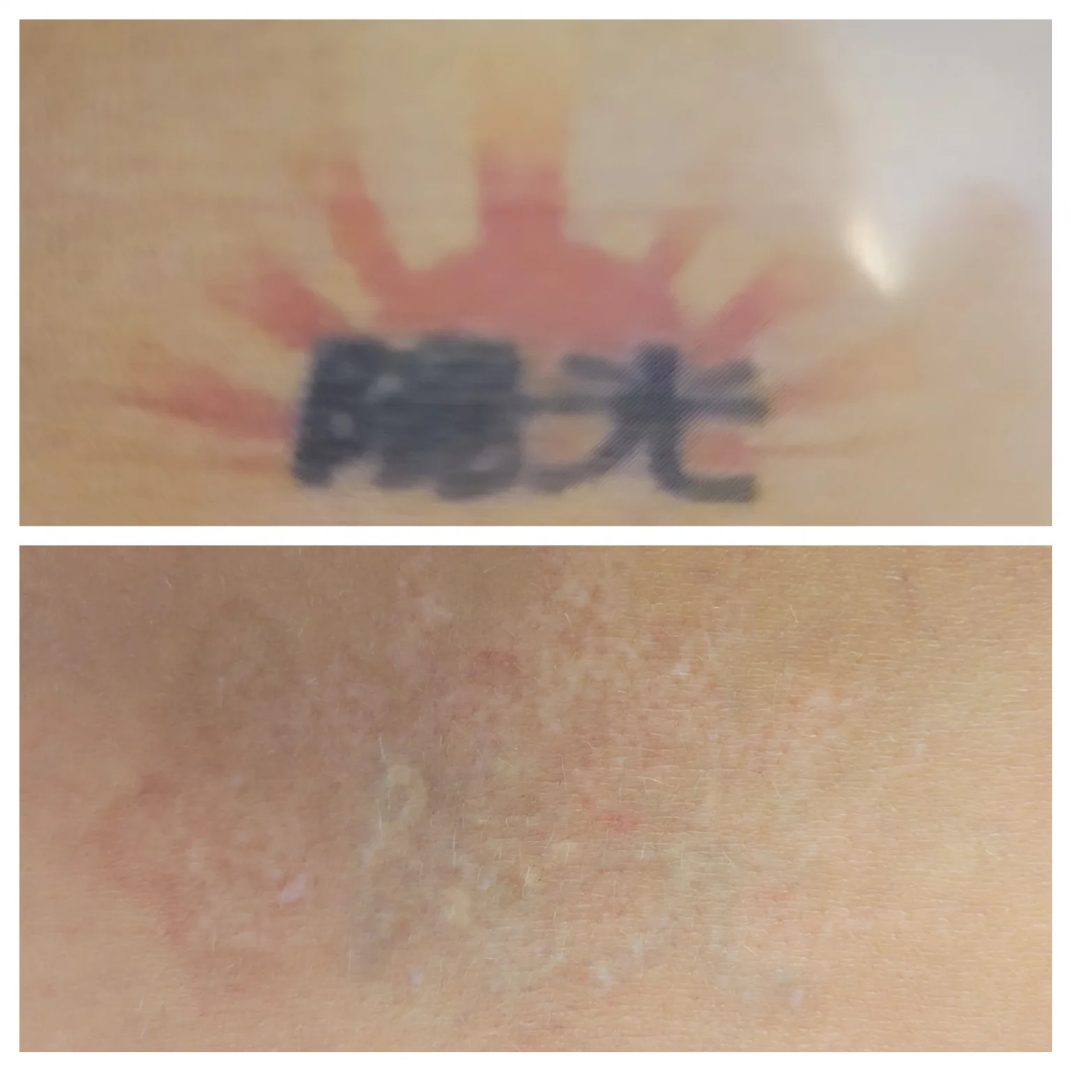 tattoo removal 1536x1536 1