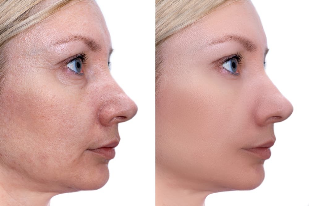 Woman face, before and after treatment - the result of rejuvenating cosmetological procedures of biorevitalization, face lifting and pigment spots, pigmentation removal Radiesse®1