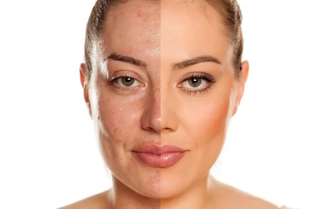 Facial Tightening Small 1 Facial Tightening Small 1