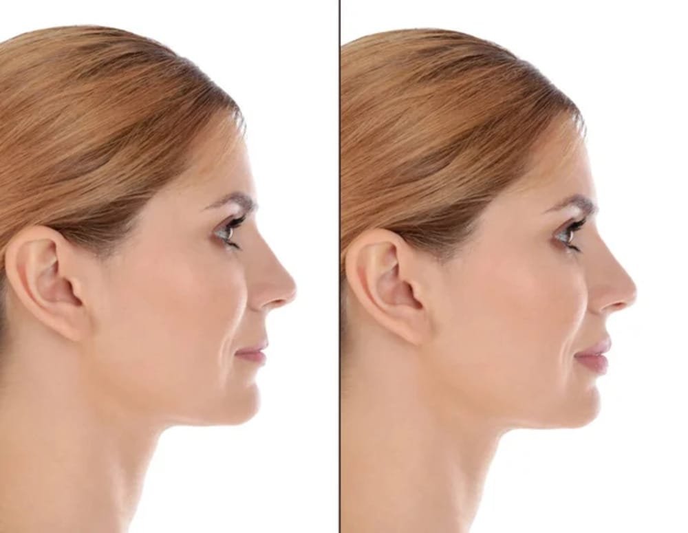 Skin Tightening Small 1 Skin Tightening Small 1