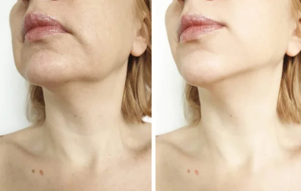 Skin Tightening Small 2 Skin Tightening Small 2