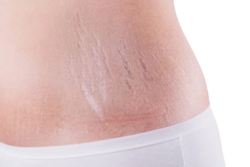 Stretch Marks Small.1pg