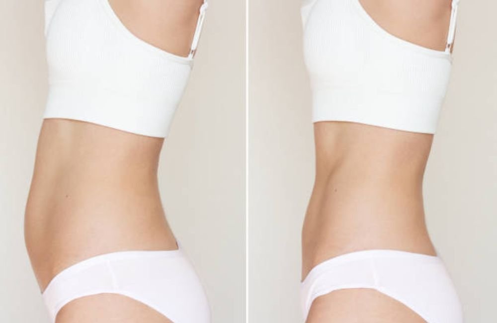 Body Contouring & Sculpting before and after