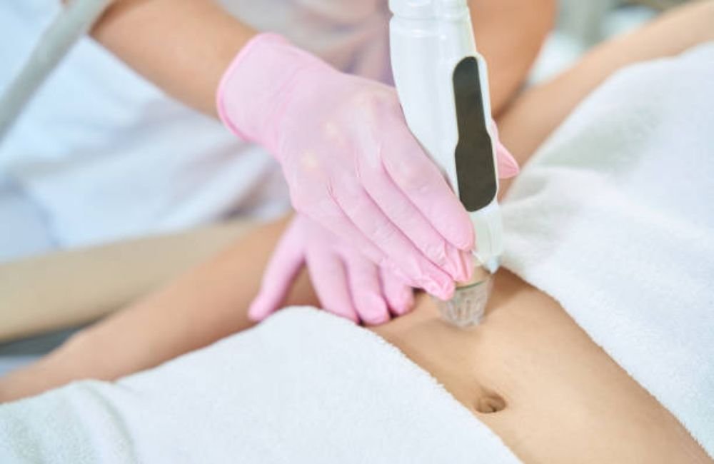 RF Microneedling In Mesa, AZ