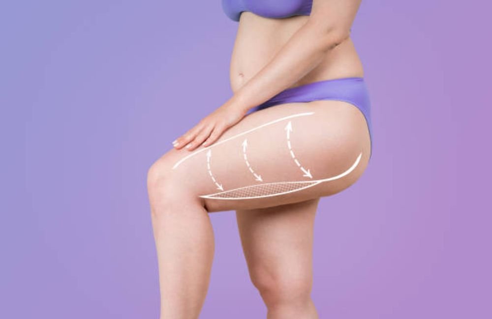 RF microneedling Mesa Az 1