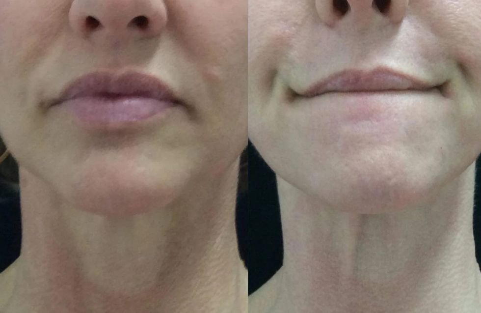 ResurFX Non-Ablative Resurfacing Scottsdale Phoenix Mesa.jpg ResurFX Non-Ablative Resurfacing Scottsdale Phoenix Mesa