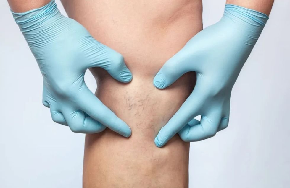 Vein & Vascular Lesion Treatment Scottsdale Phoenix Mesa Vein & Vascular Lesion Treatment Scottsdale Phoenix Mesa