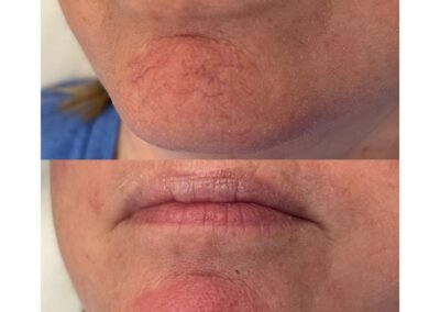 1 Spider Vein Reduction