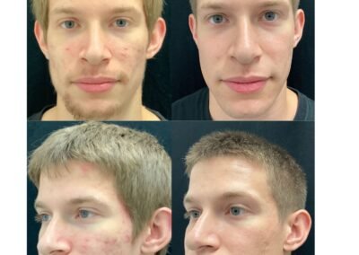 3 Radio Frequency Microneedling 2