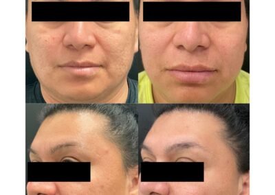 3 Radio Frequency Microneedling 3 Cool Peel