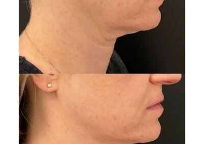 3 Radio Frequency Microneedling