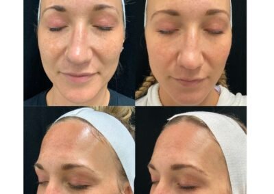 3 Traditional Microneedling