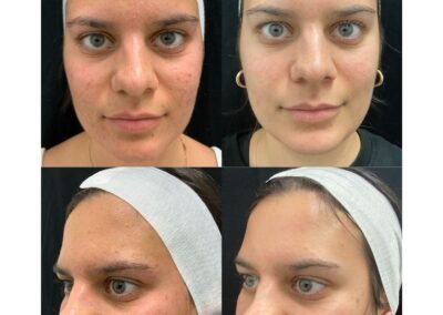 3 Traditional Microneedling 6 IPL 6 Laser Toning