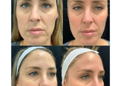 4 Traditional Microneedling
