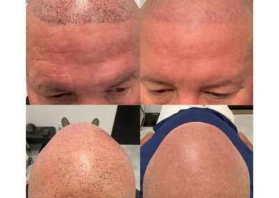 5 SMP Tattoo Removal