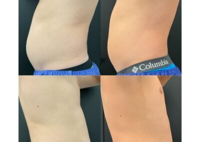 6 Body Contouring 6 PhysiQ