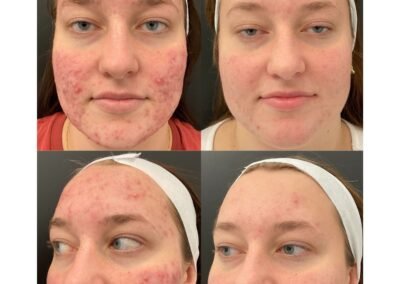 6 IPL 6 Laser Toning 6 Chemical Peel