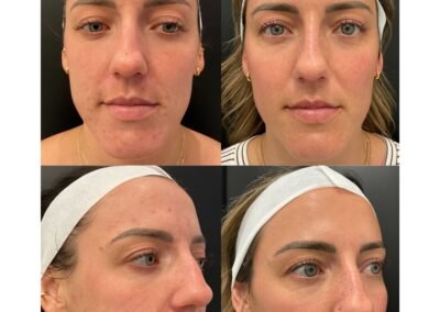 6 Traditional Microneedling 6 Laser Toning