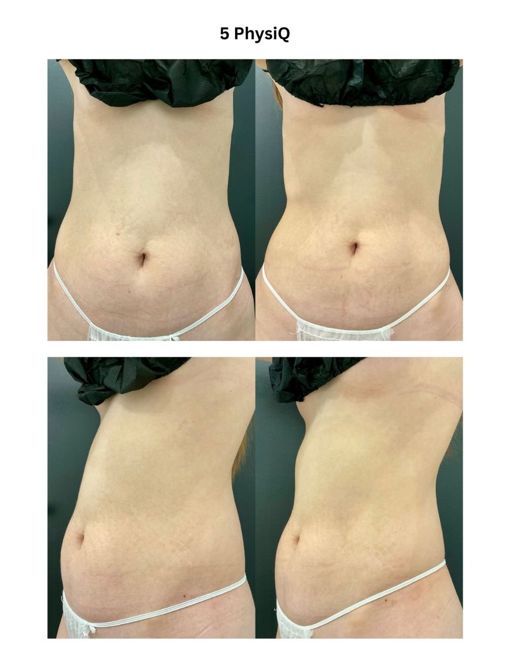 Body Contouring & Sculpting before and after