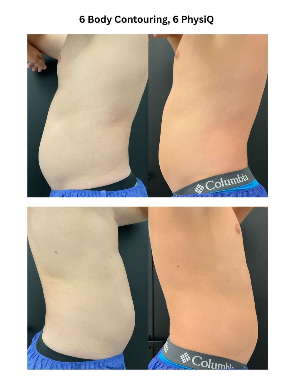Body Contouring & Sculpting before and after