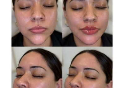 Chin Filler marionettes chin shadow Lip Filler
