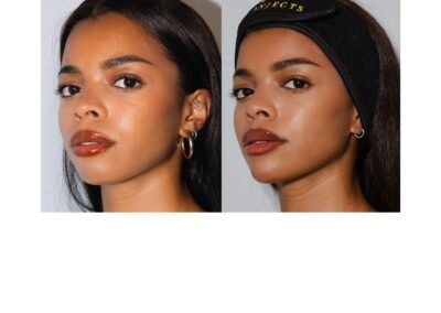 Chin and Jawline Filler