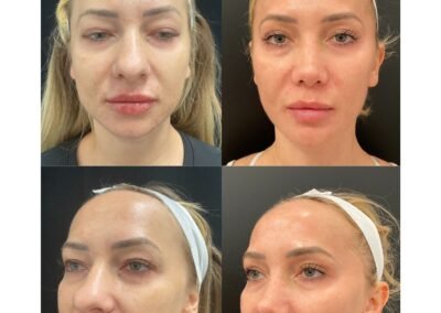 Cool Peel Laser Toning Filler Tox