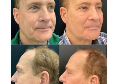 Cool Peel RFMN Filler Tox Sculptra PRF 2