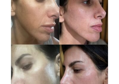 Cosmelan Peel