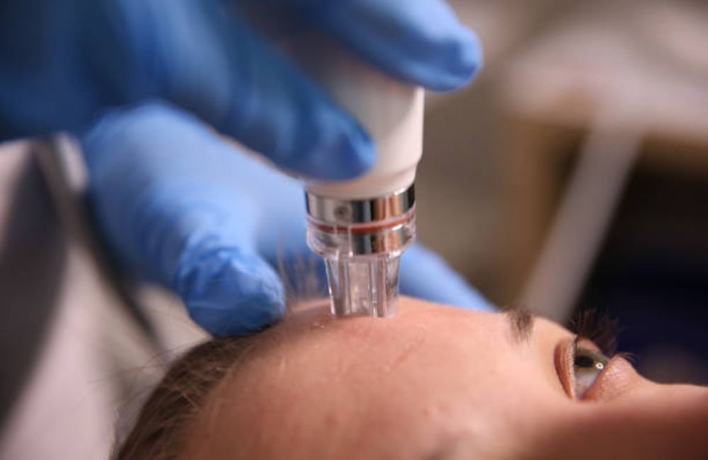 Exact RF Microneedling In East Valley, AZ