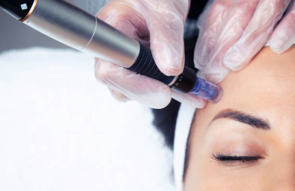 Exact RF Microneedling In East Valley, AZ