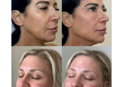 Facial balancing including filler radiuses and PRF