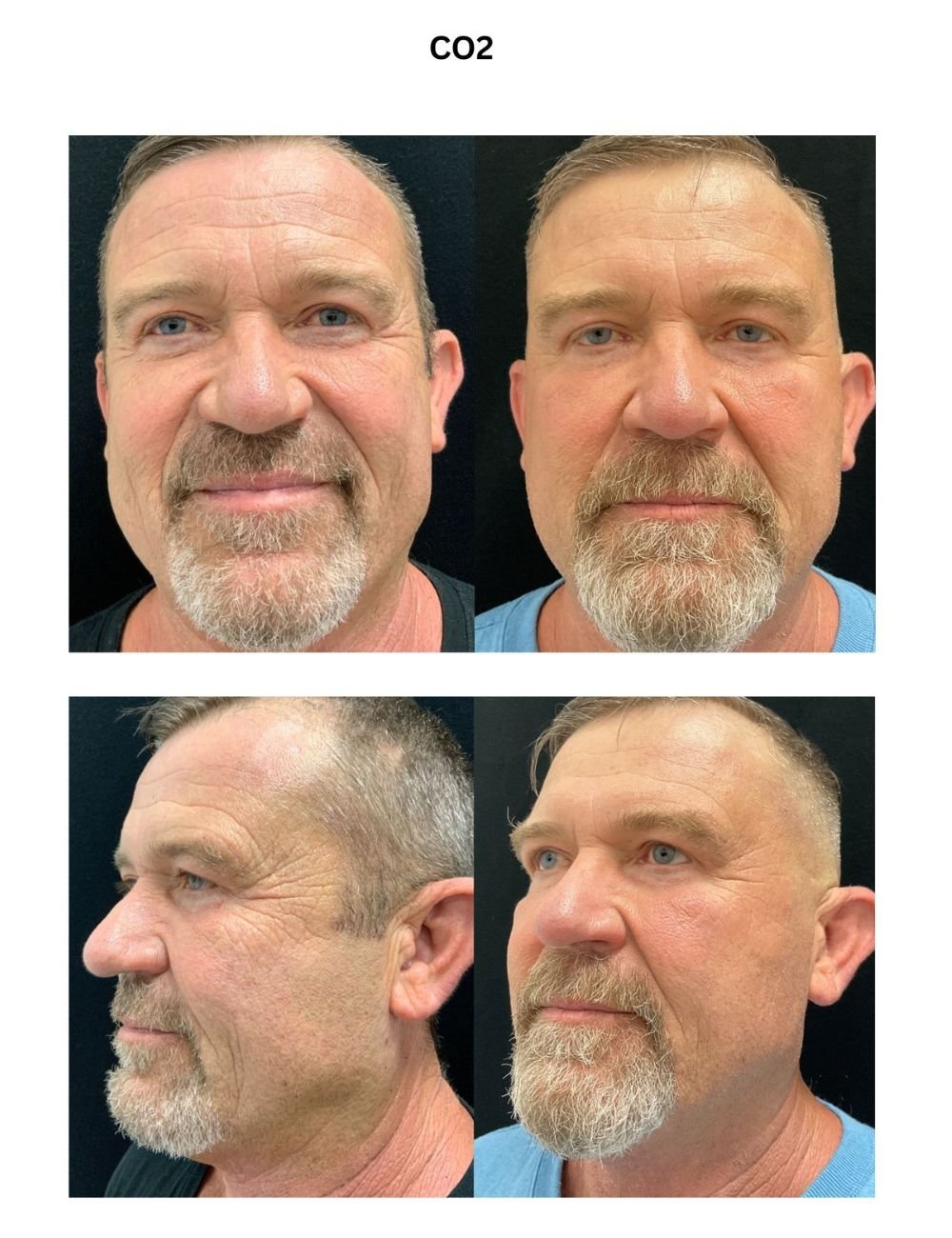 Body Contouring & Sculpting before and after