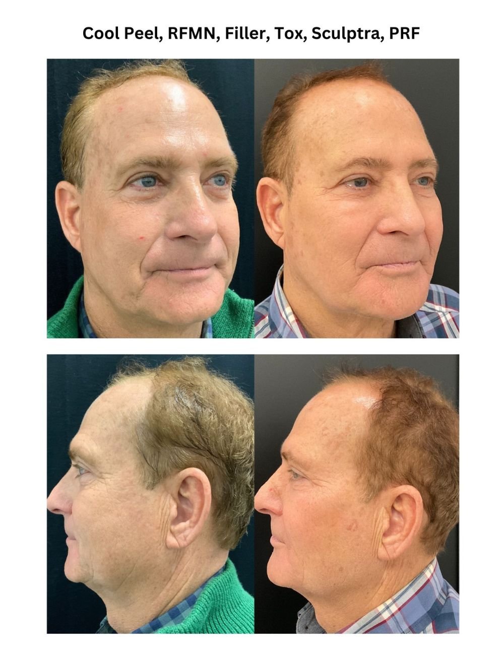 Body Contouring & Sculpting before and after