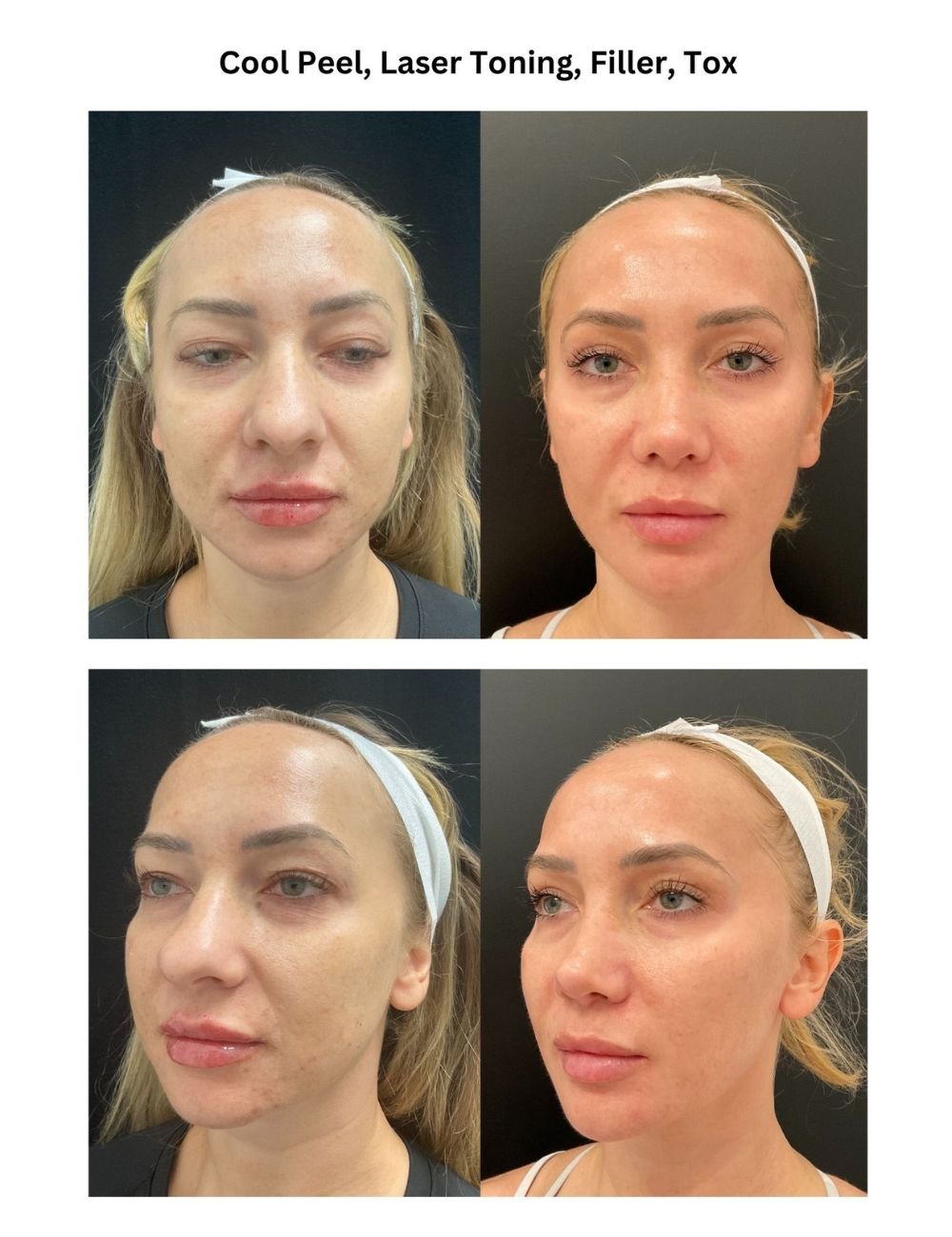 Body Contouring & Sculpting before and after