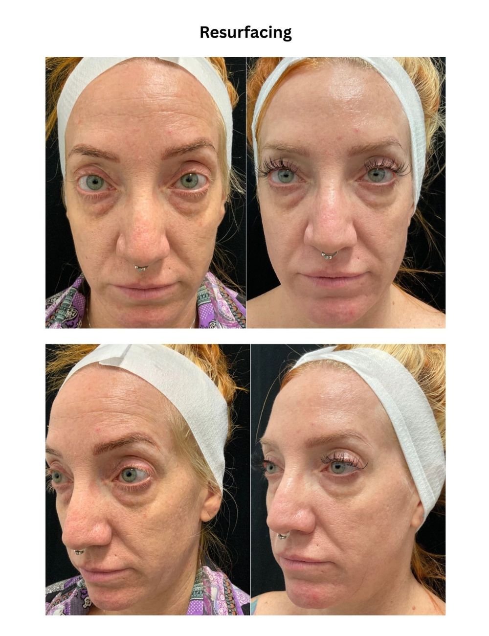 Body Contouring & Sculpting before and after