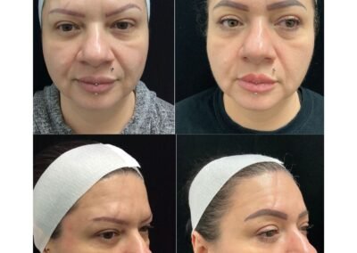 Filler Tox IPL ResurFx Laser Toning