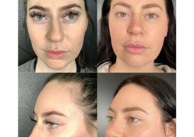 Filler Tox Resurfacing Microneedling Laser Toning 2