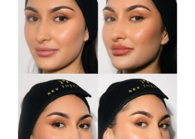 Full Facial Balancing