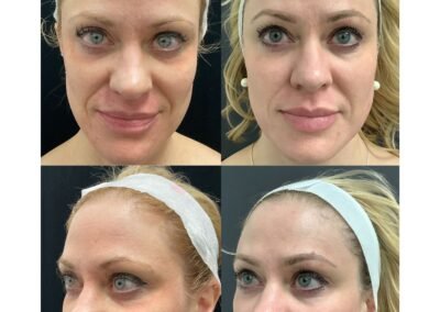 IPL Cool Peel Filler Tox Deep C02 Microneedling