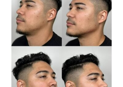 Jawline Filler 2