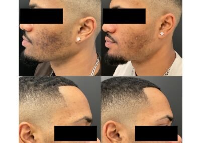 Laser Toning Laser Hair Reduction