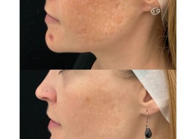 Laser Toning Radio Frequency Microneedling 2