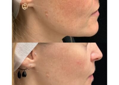 Laser Toning Radio Frequency Microneedling