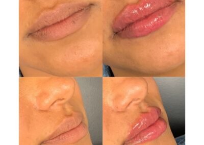 Lip Filler 3