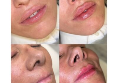 Lip Filler