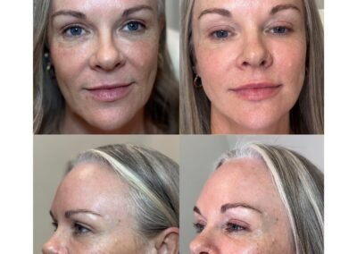 Lip filler cheek filler PRF under eyes radiuses full face jawline marionettes